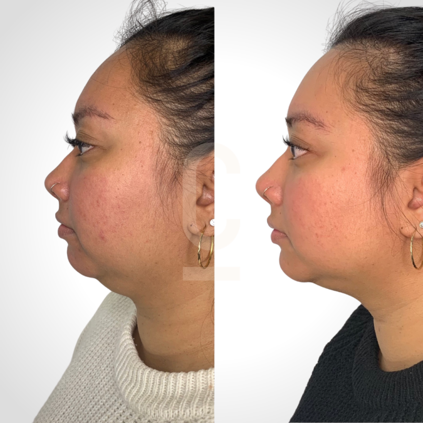 how-to-remove-double-chin-fat-non-surgically