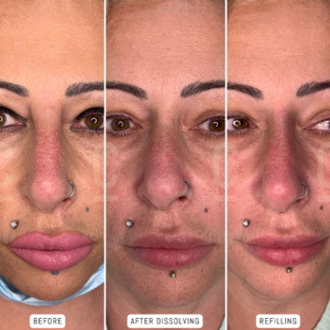 A womans face is shown in three stages: before treatment, after dissolving nose filler, and after refilling.