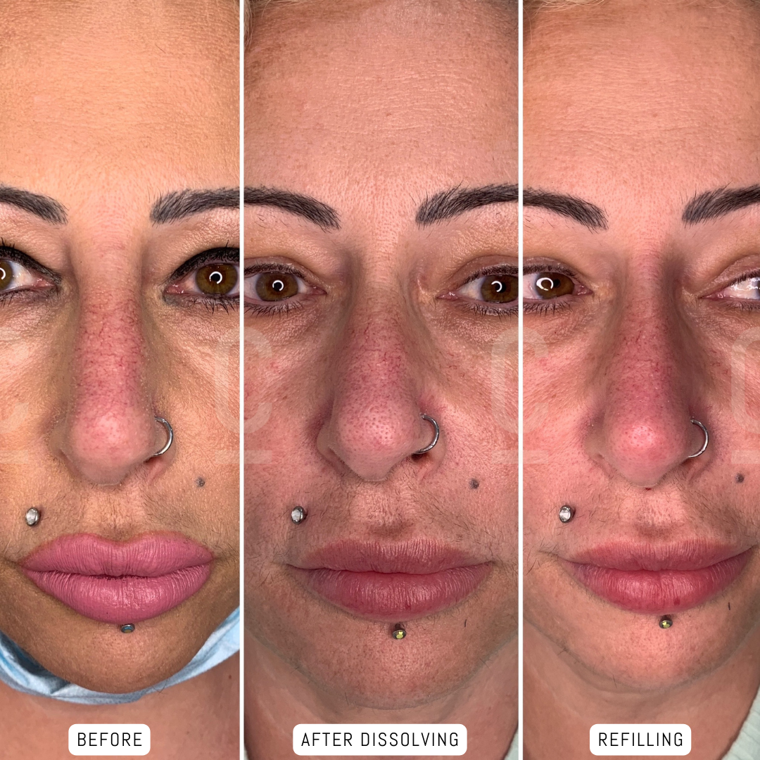 Dermal filler for Cupid's bow - Cosmetic Connection