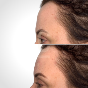 Close-up side-by-side comparison of a persons forehead and eyebrow area before and after a skin treatment. The top image shows some redness and blemishes, while the bottom image shows smoother skin with reduced redness.