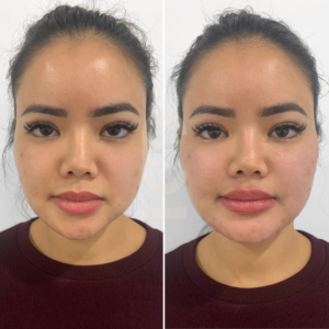 Side-by-side comparison of a womans face before and after dermal fillers, showing improved facial contours, definition, and proportions.
