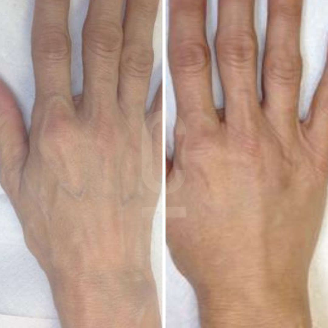 Side-by-side comparison of a hand before and after a skincare treatment. The left image shows visible veins and dry skin, while the right image displays a smoother, more hydrated appearance. Both hands are against a white background.