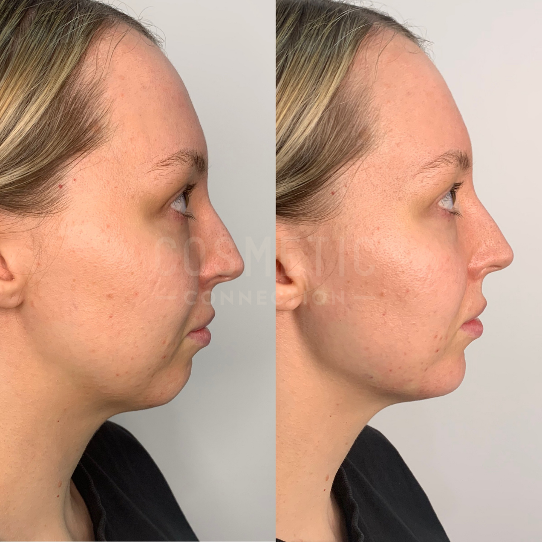 Jawline Filler for a More Sculpted Face