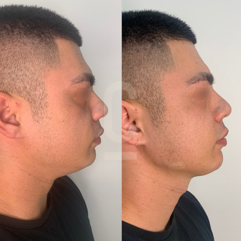 Achieving a Defined Jawline - Cosmetic Connection