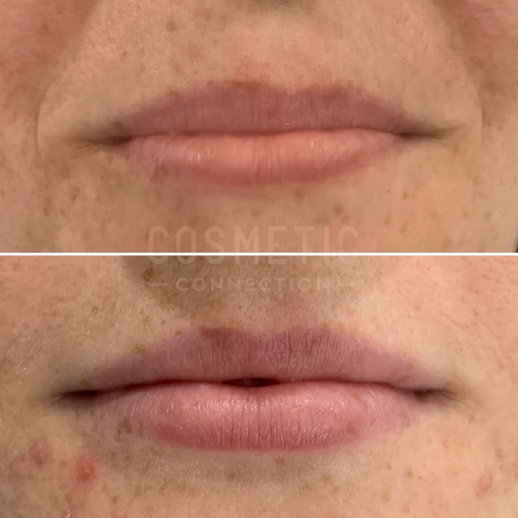 Understanding 1ml Lip Filler Impact Cosmetic Connection