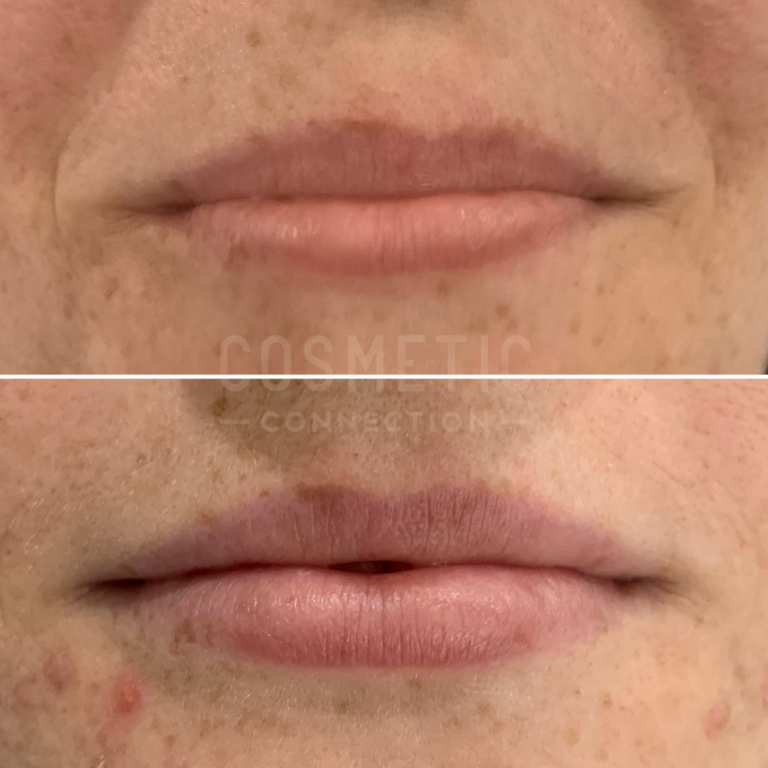 Understanding 1ml Lip Filler Impact Cosmetic Connection 6338