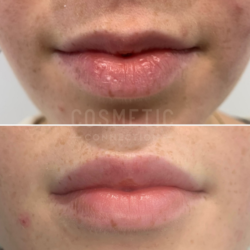 Lip Fillers Cosmetic Connection