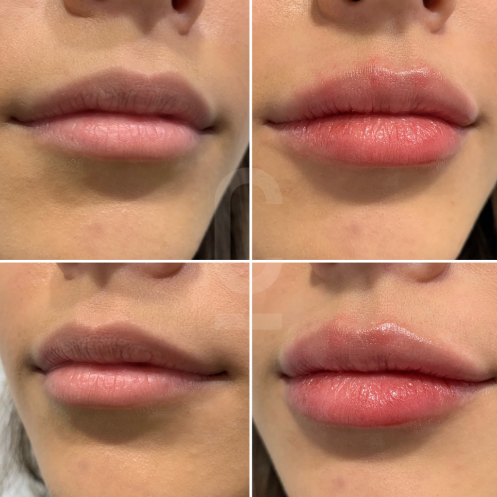 understanding-lip-filler-migration-cosmetic-connection