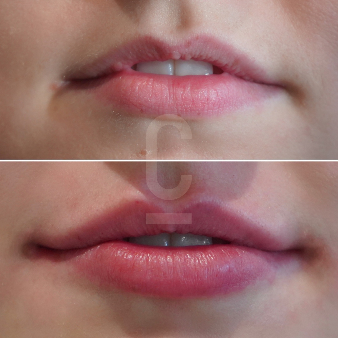 Understanding Lip Fillers And Pain Cosmetic Connection