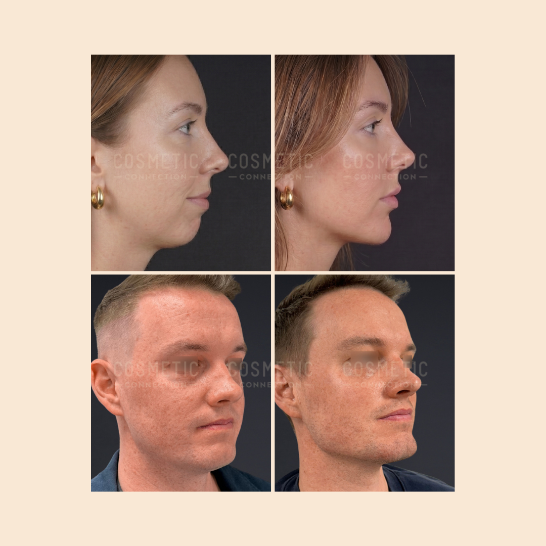 Four side-by-side before and after photos show a woman and a man, each in profile, highlighting changes to their jawlines and chins, likely from cosmetic procedures.