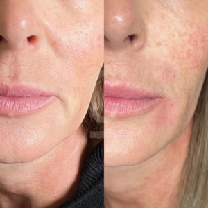 Close-up comparison of a persons face showing a skincare treatment effect. Left side displays smoother, more even-toned skin, while the right side shows redness and some skin texture.