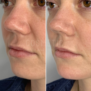 Side-by-side close-up photos of a person's lower face, showing the results of nasolabial fold dermal fillers.