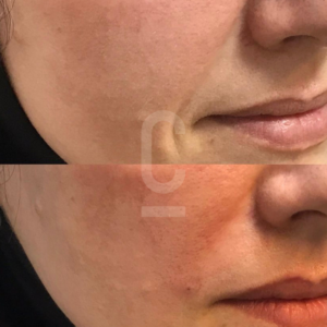 Close-up images of a persons cheek and mouth area before and after nasolabial folds dermal fillers.