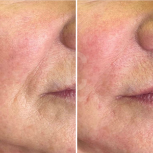 Close-up of a persons skin before and after treatment. The image is split into two sections, showing smoother, more even skin texture and reduced redness on the right side compared to the left.