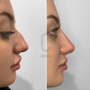 Side-by-side comparison of a womans profile before and after a cosmetic procedure, showing a change in the noses shape. The left image shows the original profile, while the right image shows the altered profile with a smoother contour.