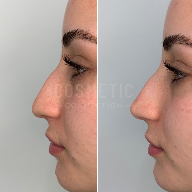 Nose Tip Lift with Dermal Filler Cosmetic Connection