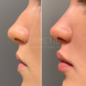 Side-by-side comparison of a persons nose and lips before and after non surgical rhinoplasty and lip filler. The left image shows the original profile, and the right image displays a visibly refined nose and fuller lips.