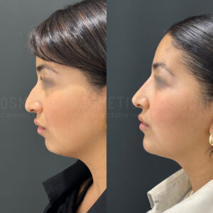 Side-by-side profile comparison of a womans face before and after cosmetic treatment. On the left, her chin and neck show more fullness; on the right, her chin appears more defined and the neck has less fullness.