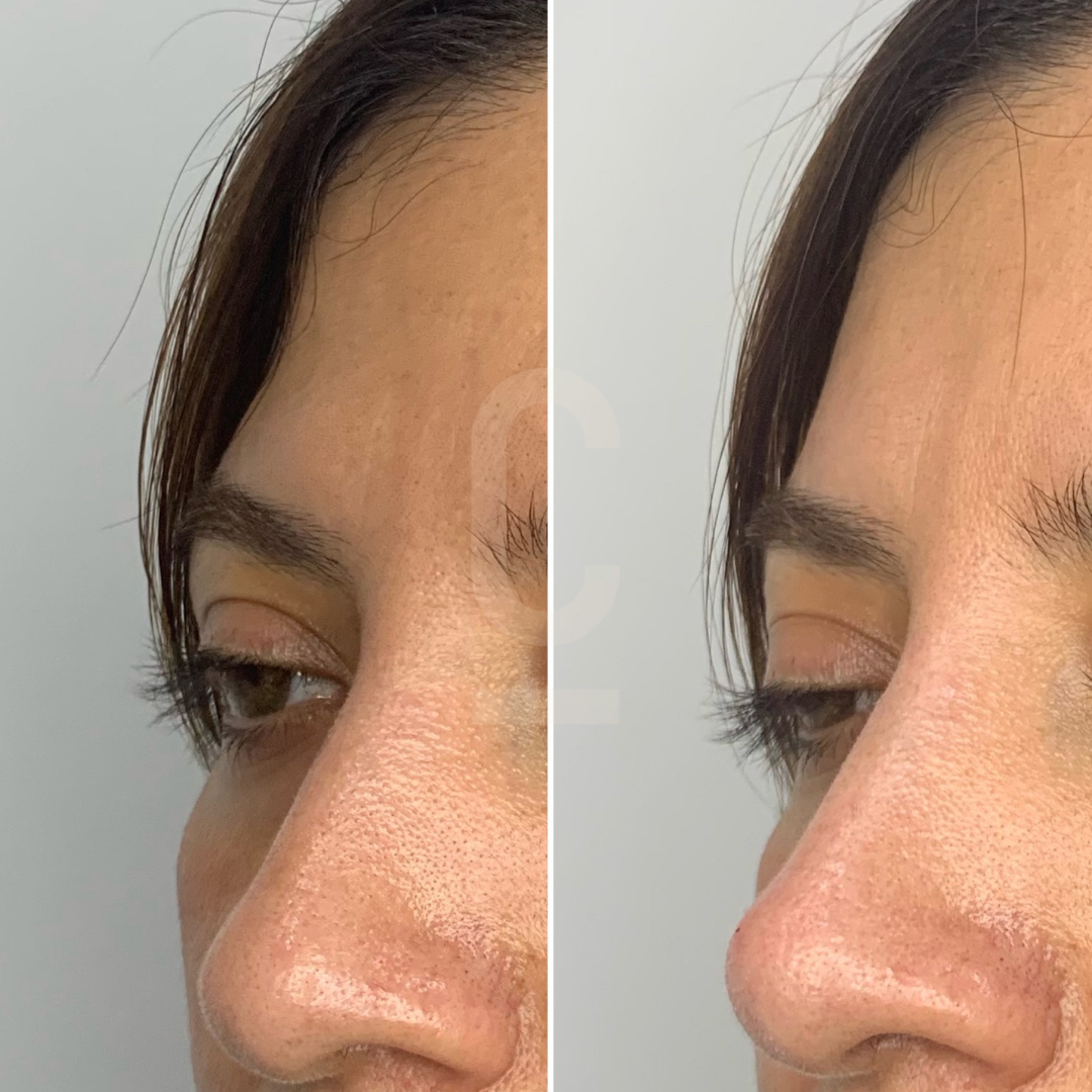 How to contour your upper face with cosmetic injectables