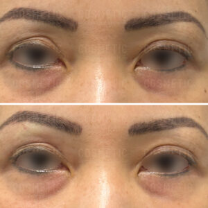 Close-up of a persons eyes shows a comparison before and after a cosmetic procedure. The top image displays more prominent under-eye bags and darker circles, while the bottom image shows reduced bags and lighter circles, indicating improvement.
