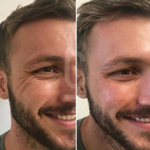 Side-by-side images of a man smiling. The left image shows his face with noticeable crows feet around the eyes. The right image shows a smoother complexion with reduced wrinkles, indicating a skincare transformation.