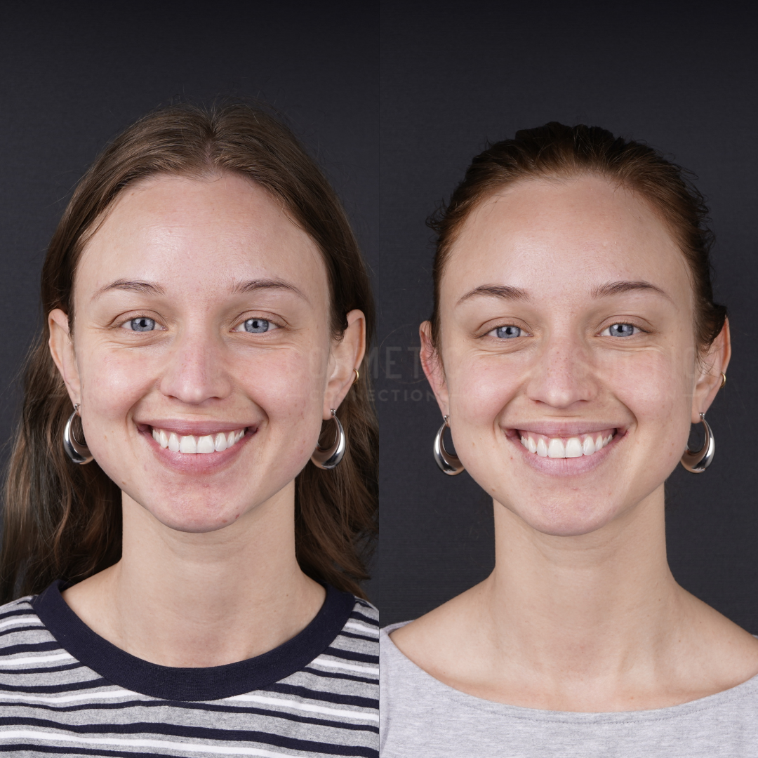 Side-by-side portraits of a young woman smiling against a dark background, wearing hoop earrings; left image with hair down in a striped shirt, right image with hair tied back in a light shirt.