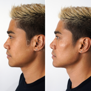 Side-by-side profile views of a person with short, blond-highlighted hair and earrings, showing a before and after comparison of a cosmetic procedure. The lighting and background are consistent in both images.