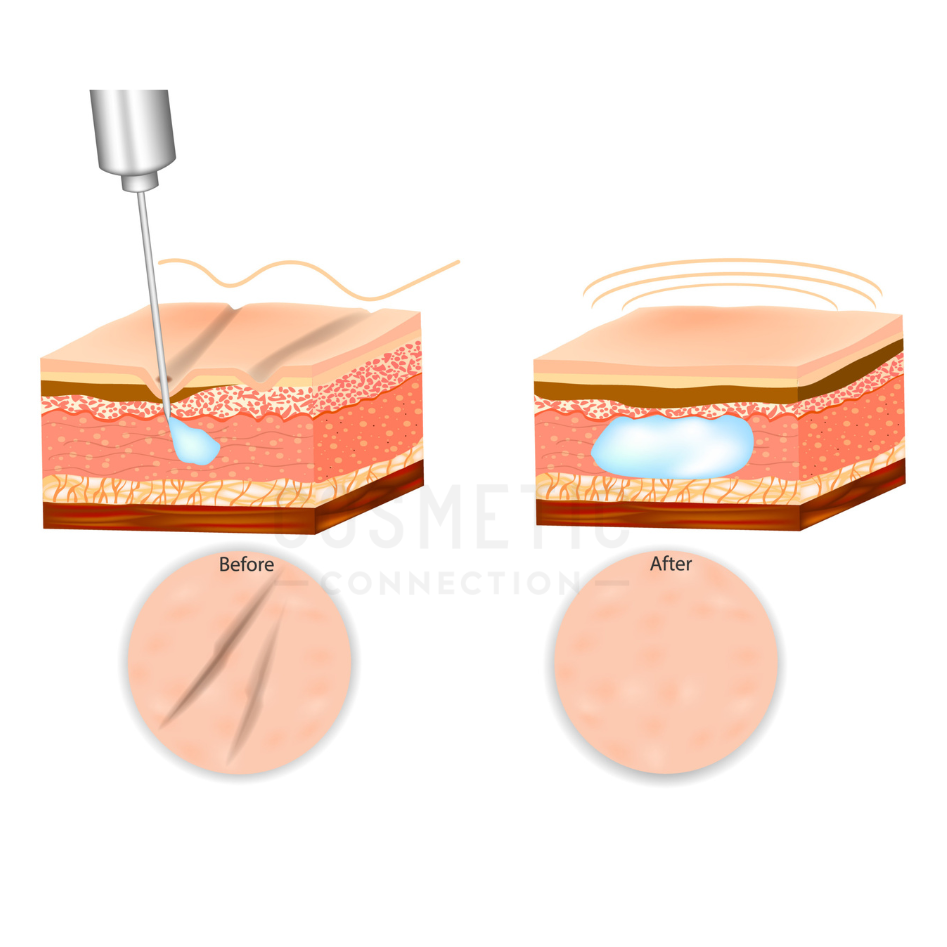 Illustration of a dermal filler procedure, showing a needle injecting filler under the skin. The before section displays wrinkles, and the after section shows smooth skin. Labeled Dermal filler for wrinkles with a Cosmetic Connection watermark.