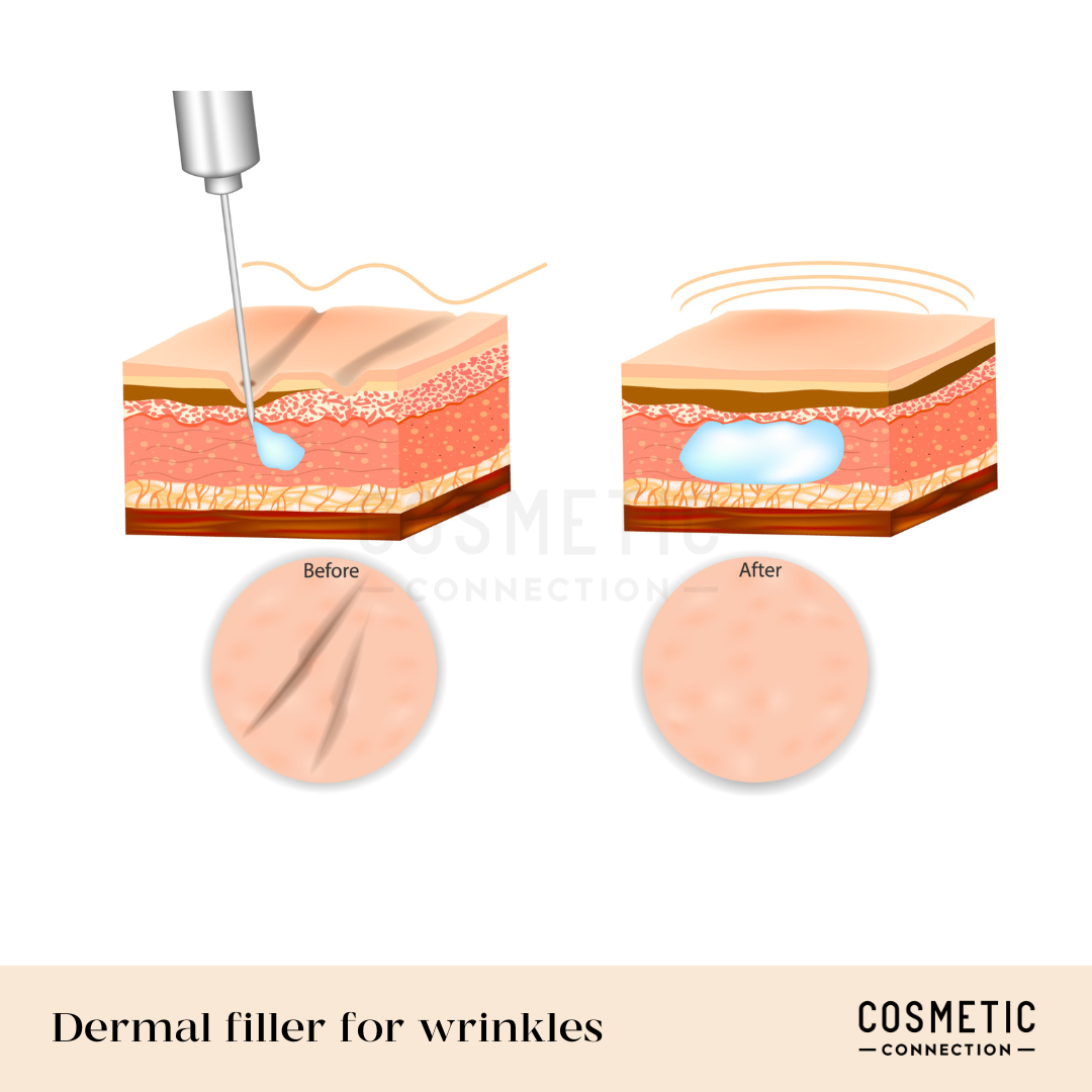 Illustration of a dermal filler procedure, showing a needle injecting filler under the skin. The before section displays wrinkles, and the after section shows smooth skin. Labeled Dermal filler for wrinkles with a Cosmetic Connection watermark.