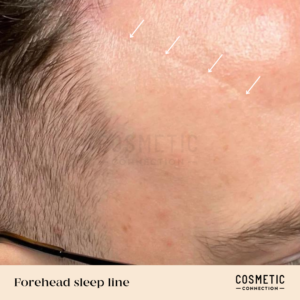 Close-up of a persons forehead showing horizontal sleep lines, highlighted by arrows. The skin texture and light hair are visible. Text at the bottom reads Forehead sleep line with a Cosmetic Connection logo.