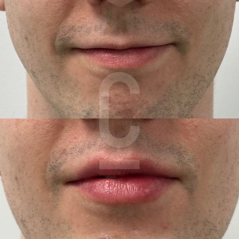 Understanding 1ml Lip Filler Impact Cosmetic Connection 0460