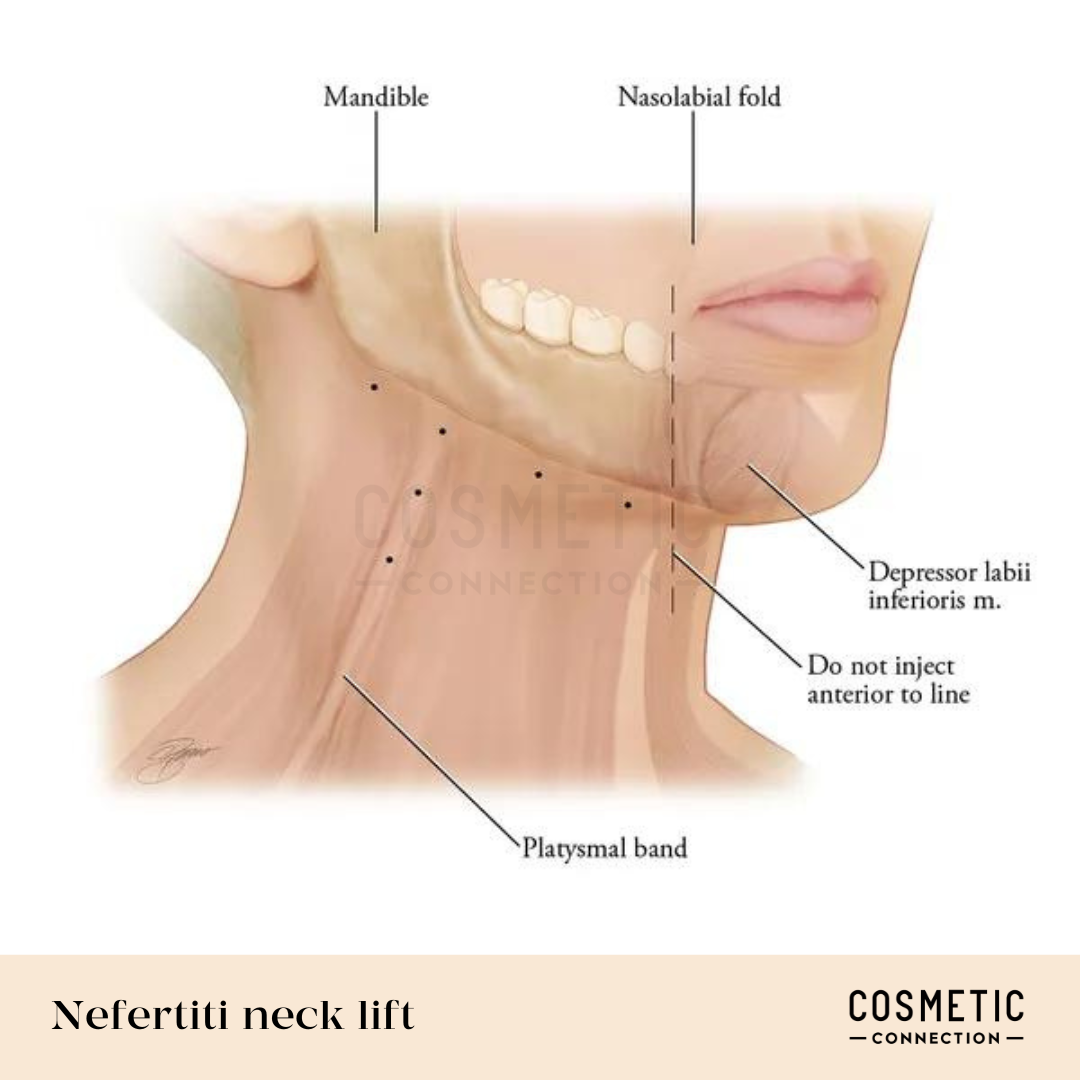 Illustration showing a side view of a neck and lower face labeled with anatomical features for a Nefertiti neck lift. Labels include: mandible, nasolabial fold, depressor labii inferioris muscle, platysmal band, and injection line guidance.