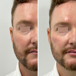 Side-by-side images show a persons face before and after a cosmetic procedure. The skin appears smoother on the right side of the image. The persons eyes are obscured for privacy.