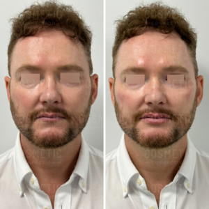 Side-by-side images showing a mans face before and after a cosmetic procedure. He has fair skin, brown curly hair, and a beard. The after photo shows smoother skin, fuller cheeks, and enhanced facial symmetry. Hes wearing a white collared shirt.