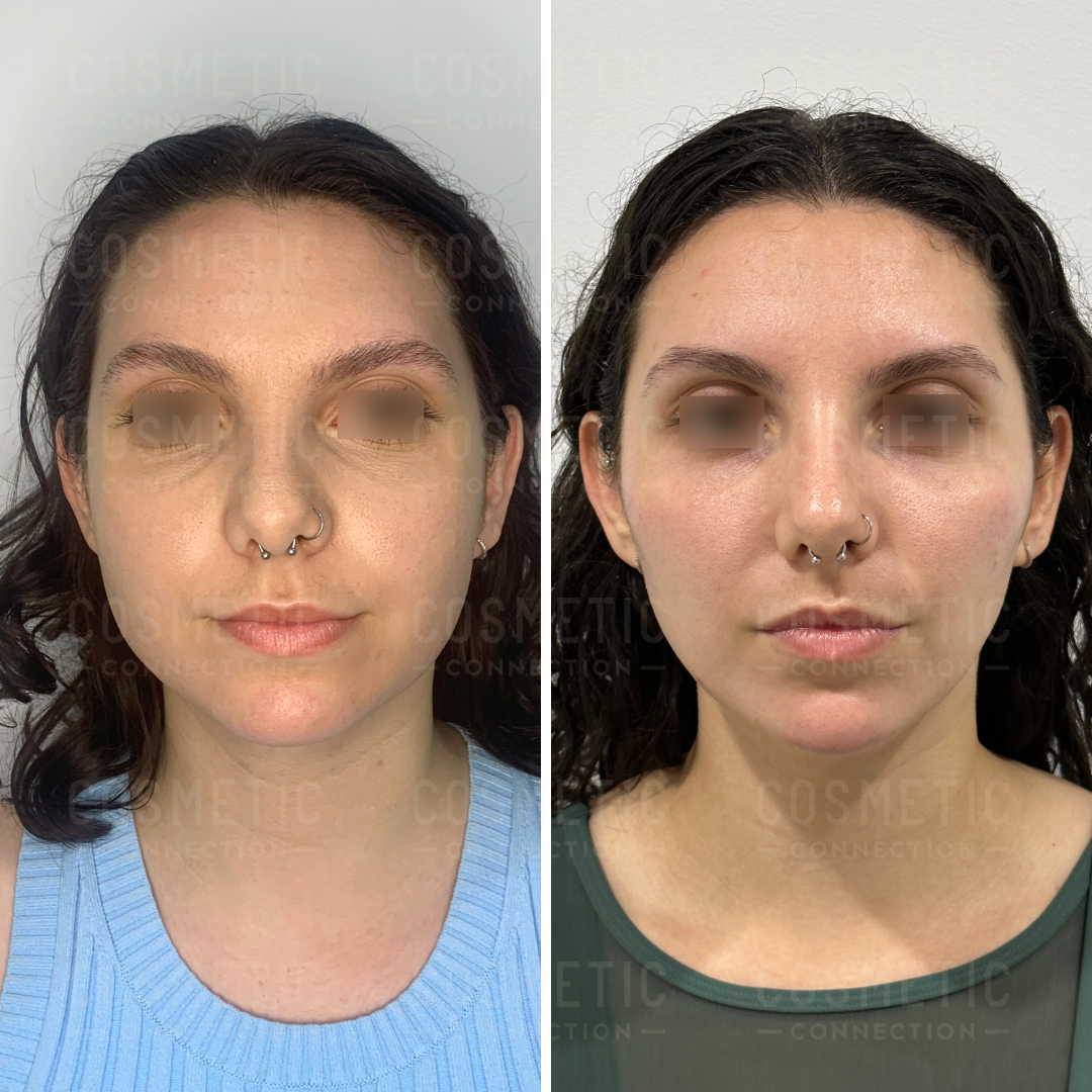 Jawline Slimming Injections