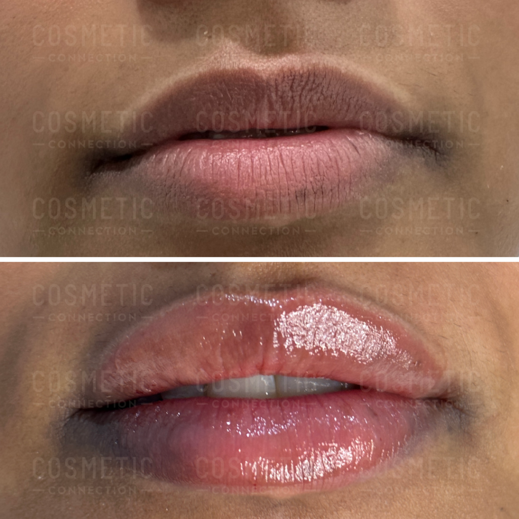 Understanding 1ml Lip Filler Impact Cosmetic Connection