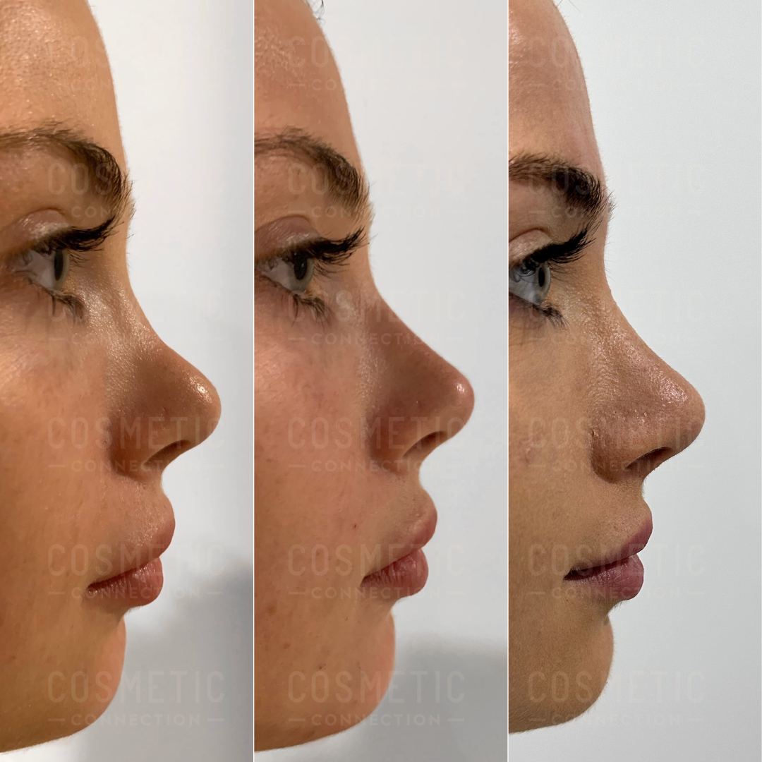 Premium Photo  Transformation of woman's nose through rhinoplasty