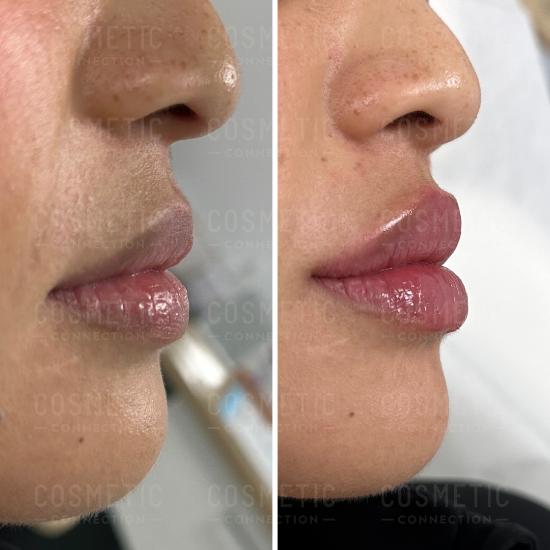 What happens when lip fillers wear off? - Cosmetic Connection