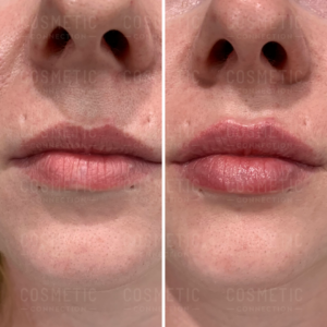 Close-up before and after comparison of a person’s lips and lower face, showing increased lip volume and smoothness following lip filler injections. The skin texture also appears more refined in the after image on the right.