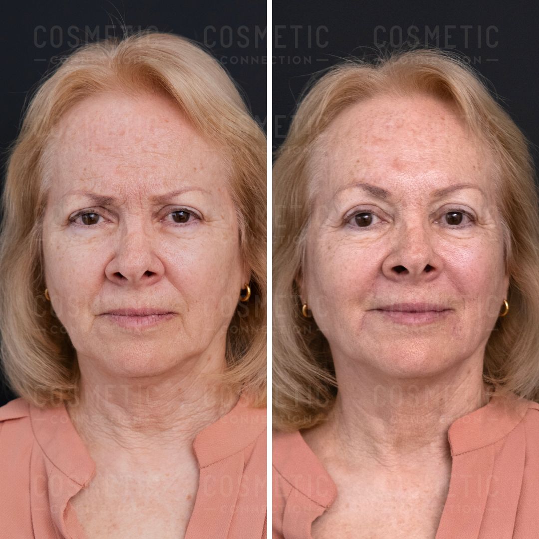 Side-by-side comparison of an older woman before and after a cosmetic procedure. The left image shows her with a neutral expression, and the right image shows her smiling slightly. She has shoulder-length blonde hair and is wearing a peach blouse.