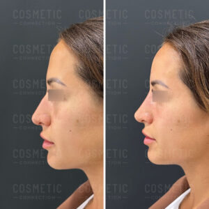 Side-by-side profile images of a womans face with her eyes obscured. The left image shows the nose before a cosmetic procedure, and the right image shows the nose after the procedure, highlighting a more refined shape.