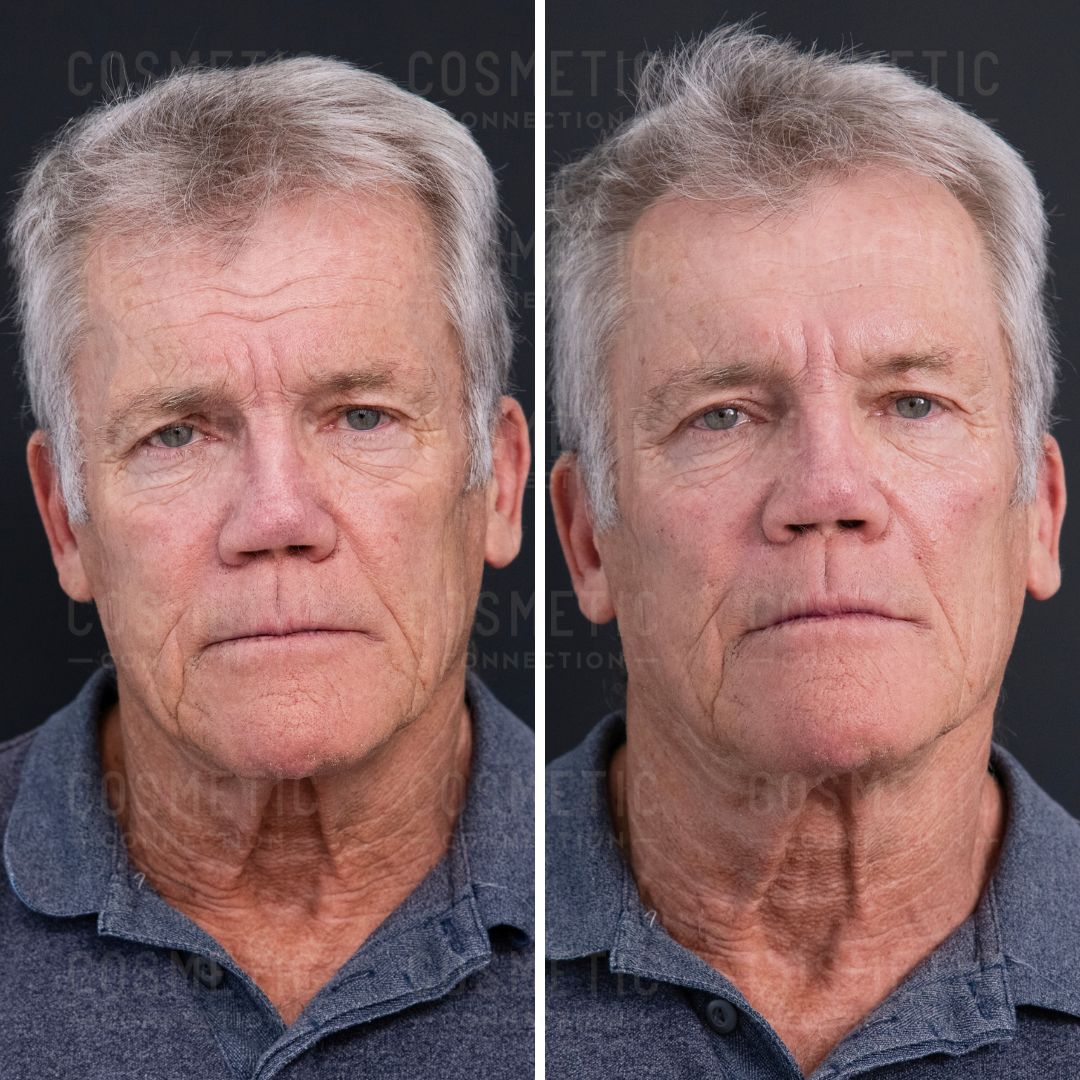 Side-by-side comparison of an older man with gray hair in before and after photos, showing facial differences. Both images have a black background, and he is wearing a gray polo shirt.