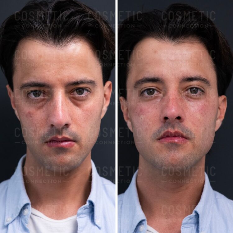 Under Eye Hollow Filler Before After How Long Does It Last - m3zj9es