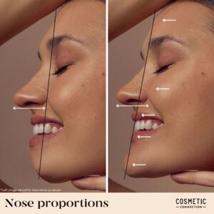 Close-up of a womans side profile, showing nose proportions. Left image has a black line highlighting the nose angle, and the right image includes white arrows pointing to the nose, lips, and chin, demonstrating ideal facial symmetry.