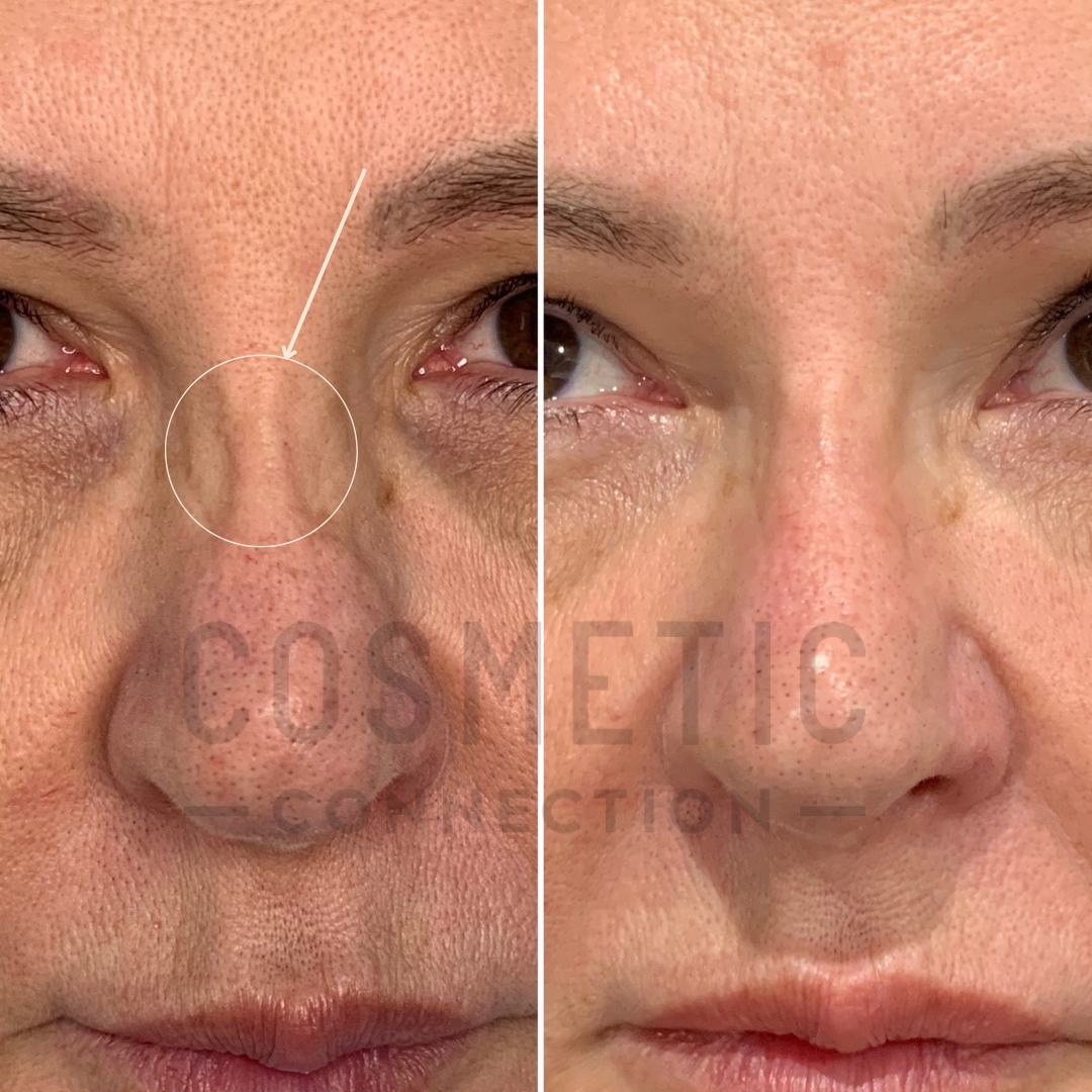 Nose fillers vs nose thread lifts Cosmetic Connection