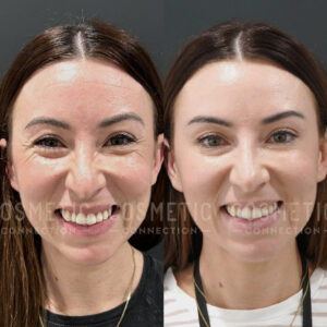 Side-by-side comparison of a womans face before and after botox for wrinkles, showing smoother skin and fewer lines in the after photo on the right.