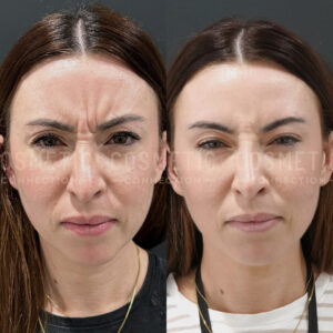 Side-by-side comparison of a womans face before and after botox for wrinkles, showing smoother skin and fewer lines in the after photo on the right.