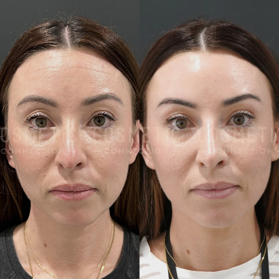 Side-by-side comparison of a womans face, showing changes before and after a cosmetic procedure. The left image shows her with natural features, and the right image displays smoother skin and enhanced facial contours. Both images have a dark background.