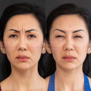 Side-by-side comparison of a womans face before and after botox for wrinkles, showing smoother skin and fewer lines in the after photo on the right.
