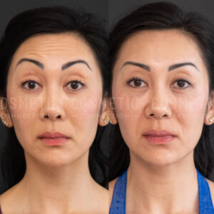 Side-by-side comparison of a womans face before and after botox for wrinkles, showing smoother skin and fewer lines in the after photo on the right.
